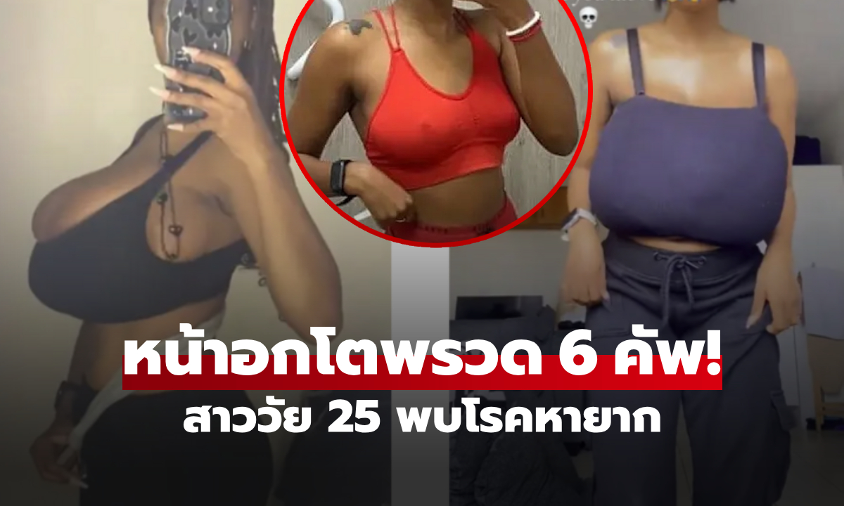 หน้าอกแบนๆ กลายเป็นสะบึ้ม!!! ภายในไม่กี่เดือน สาวร้องไห้รู้สาเหตุ ทั่วโลกมีแค่ 300 คน