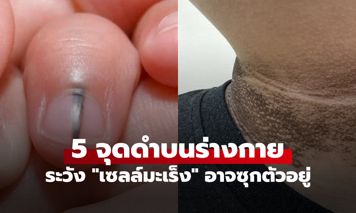 ถ้ามีเซลล์มะเร็งในร่างกาย อวัยวะ 5 ส่วนนี้อาจเริ่ม “ดำคล้ำ” อย่างผิดปกติ อย่าชะล่าใจ!
