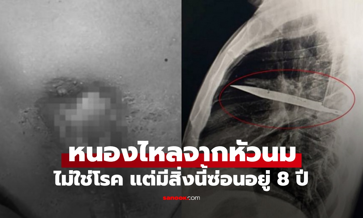 หมอตกตะลึง คนไข้หนองไหลจากหัวนมขวา ไม่ได้เป็นโรค แต่มี "สิ่งนี้" ซ่อนอยู่ 8 ปี