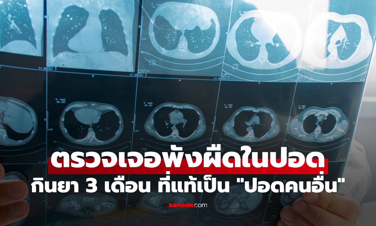 คนไข้อึ้ง หมอบอกเป็นพังผืดในปอด กินยา 3 เดือน จริงๆ ที่ป่วยคือ "ปอดคนอื่น"
