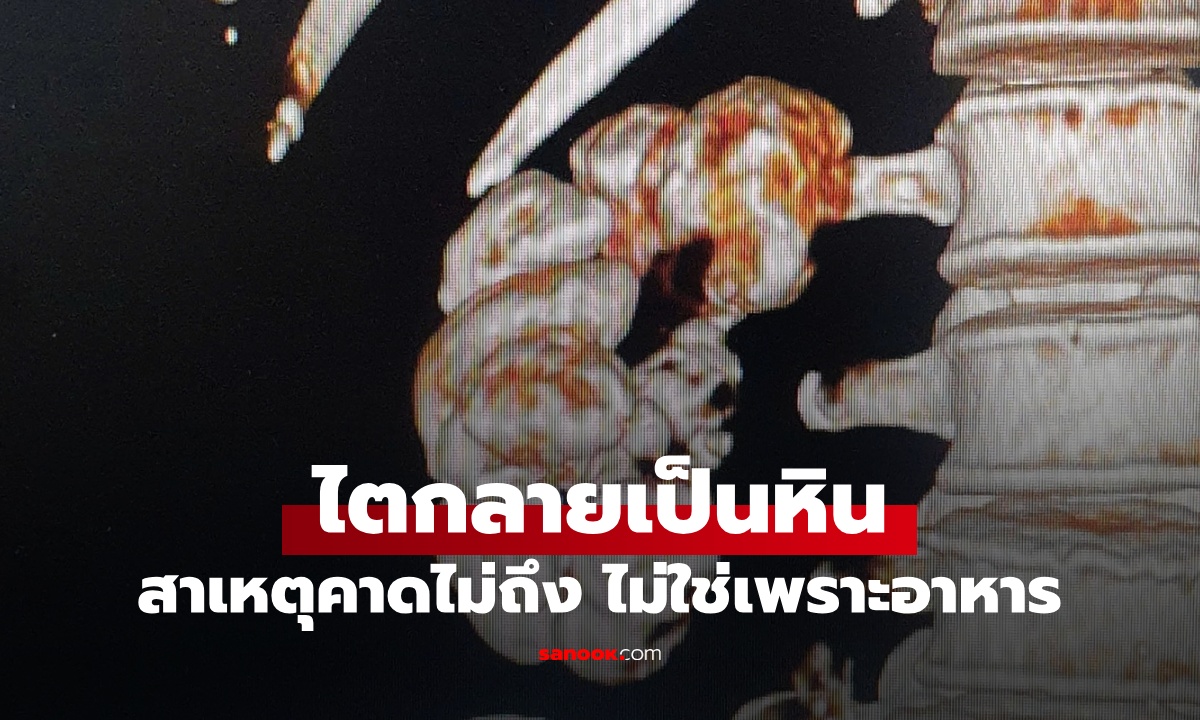 ไตกลายเป็นหิน ต้องตัดทิ้ง 1 ข้าง หมอเผยสาเหตุคาดไม่ถึง ไม่ได้มาจากอาหาร