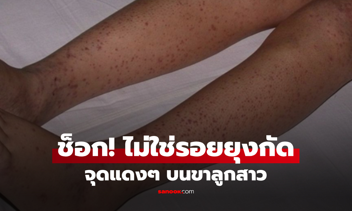 อาบน้ำให้ลูก พบจุดแดงๆ ตามขา นึกว่าแค่ยุงกัด แต่ผลตรวจชี้ "โรคร้าย" ทรุดทั้งบ้าน!