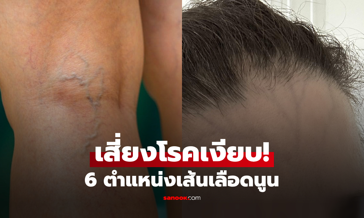 บ่งบอกอะไร? เช็กตำแหน่ง "เส้นเลือดนูน" หากขึ้นตรง 6 จุดอันตราย เสี่ยงโรคเงียบ!