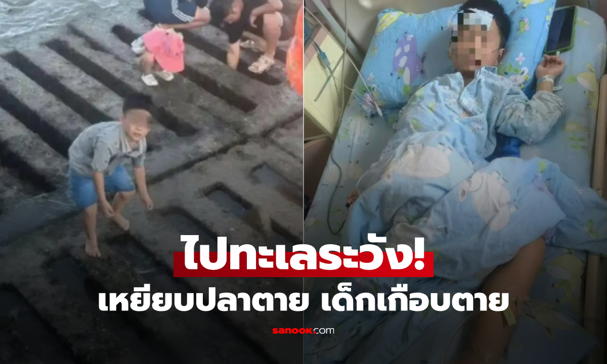 ช็อก! ลูกชาย 6 ขวบเกือบตาย เพราะเหยียบปลาตาย ติดเชื้อ "ฆาตกรเงียบแห่งท้องทะเล"