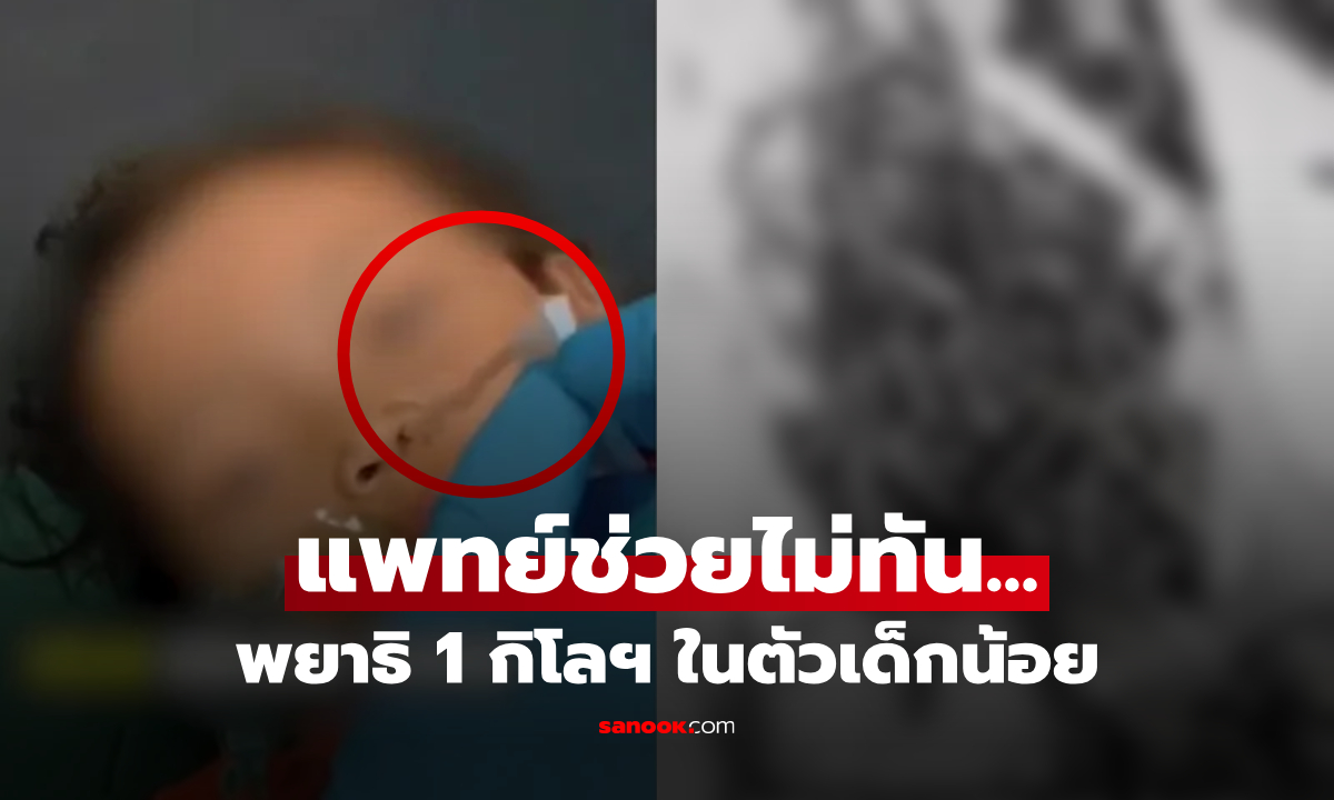 เกิดอะไรขึ้น? ไวรัลช็อก พยาธิโผล่รูจมูกเด็ก 4 ขวบ ขับออกมาเกิน 1 กิโล หมอสุดยื้อชีวิต