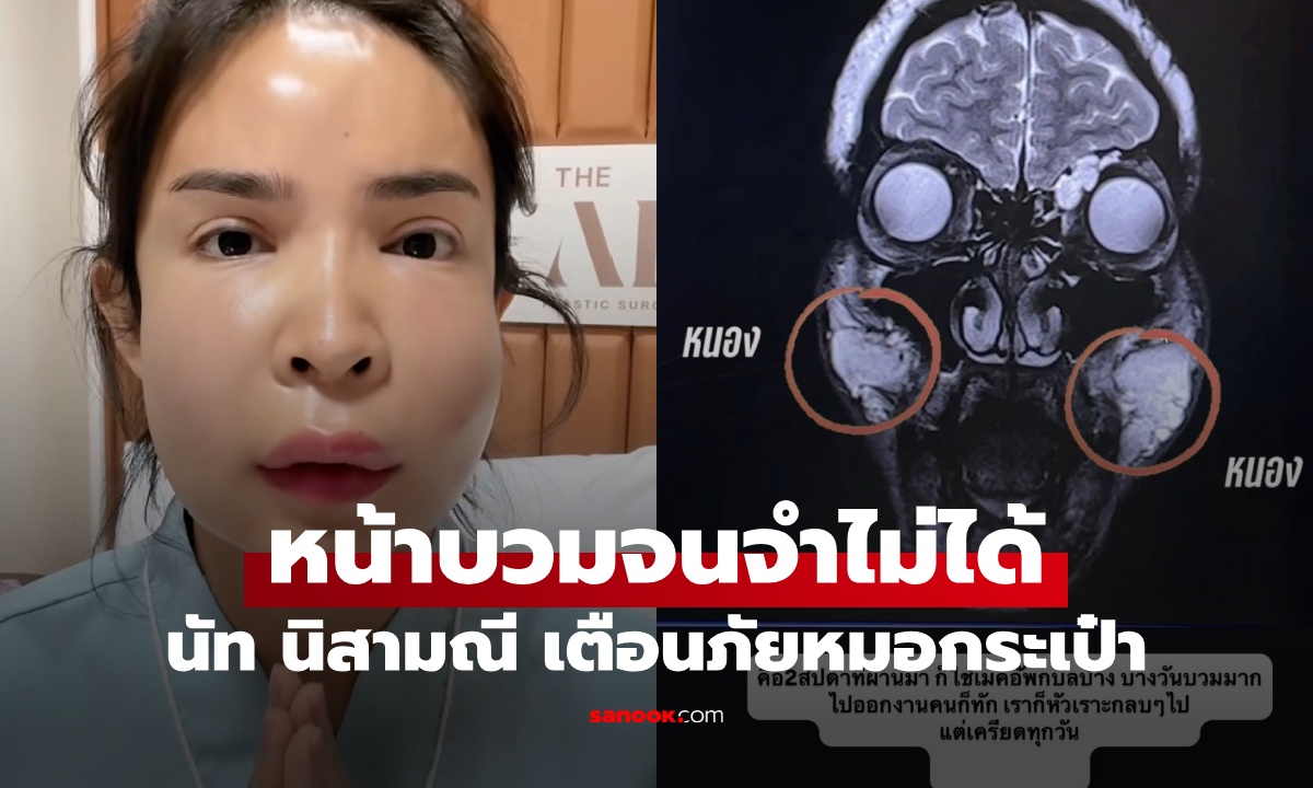 บวมจนจำไม่ได้ “นัท นิสามณี” เตือนภัยฉีดหน้าหมอกระเป๋า ระเบิดเวลา 10 ปีเพิ่งปะทุ