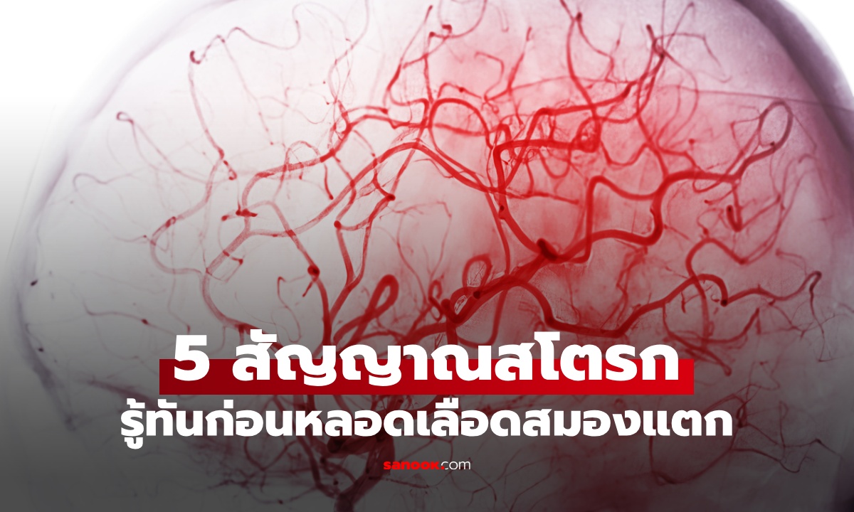 รู้ทันสโตรก 5 สัญญาณเตือน เส้นเลือดในสมองแตก หลอดเลือดตีบ จำกฎนี้ให้แม่น!