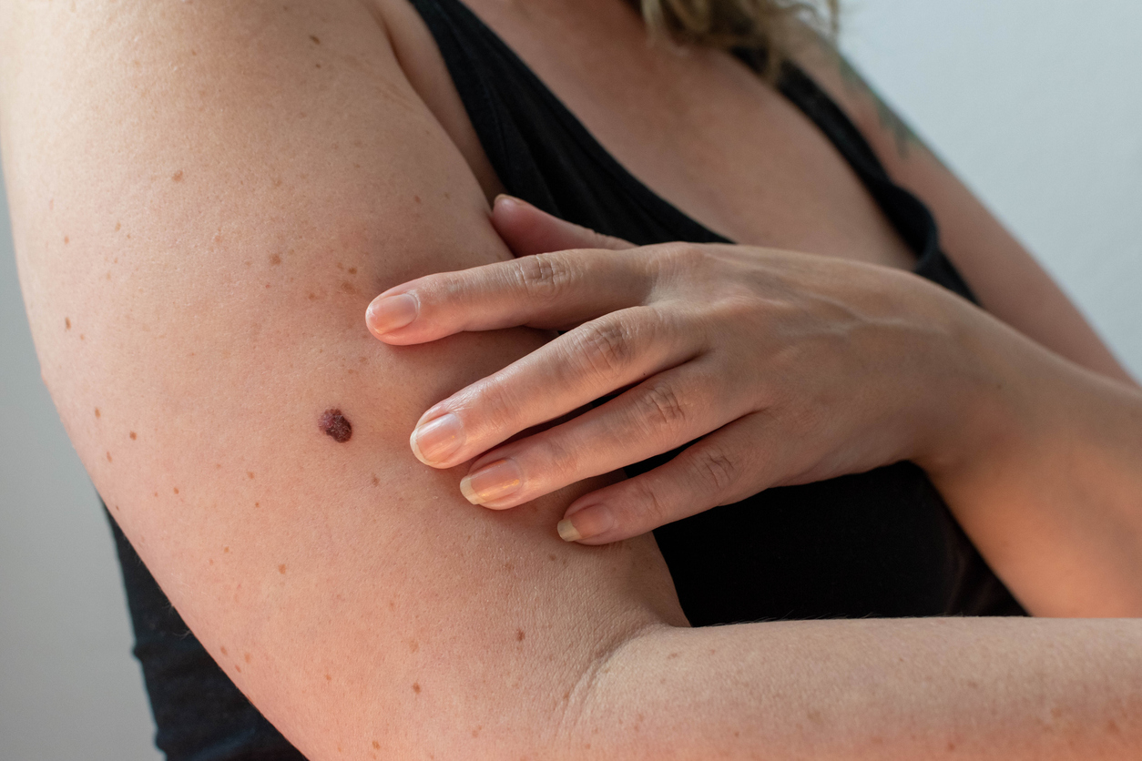 mole-melanoma-spotting-skin-c