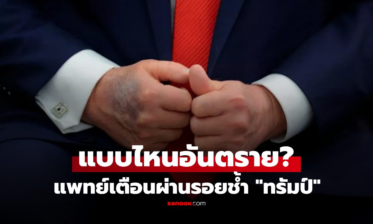 รอยช้ำแบบไหน "อันตรายถึงชีวิต" แพทย์เตือนผ่านเคส "ทรัมป์" เส้นเลือดดำบกพร่อง!