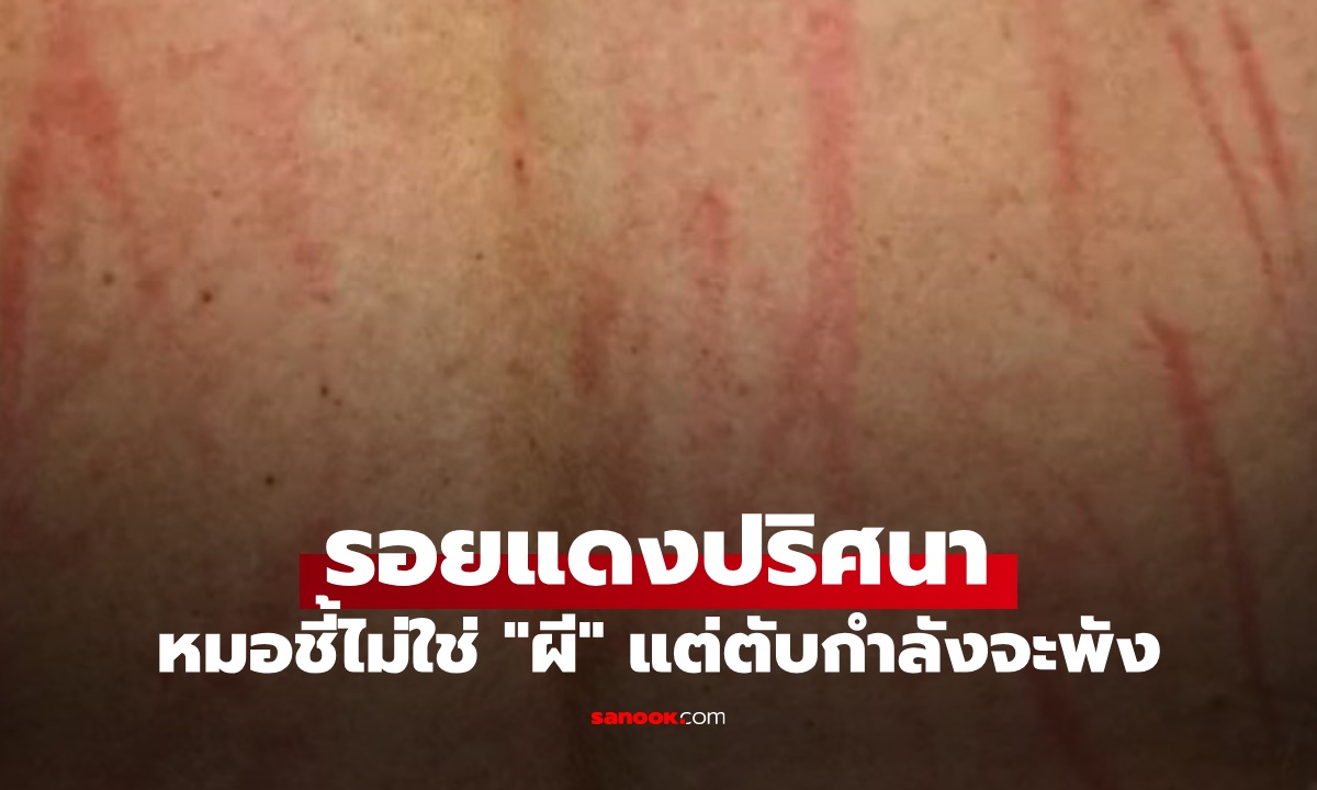 รอยแดงทั่วตัว เชื่อเป็นฝีมือ "ผี" แพทย์ชี้เป็นสัญญาณ "ตับ" ขอความช่วยเหลือ