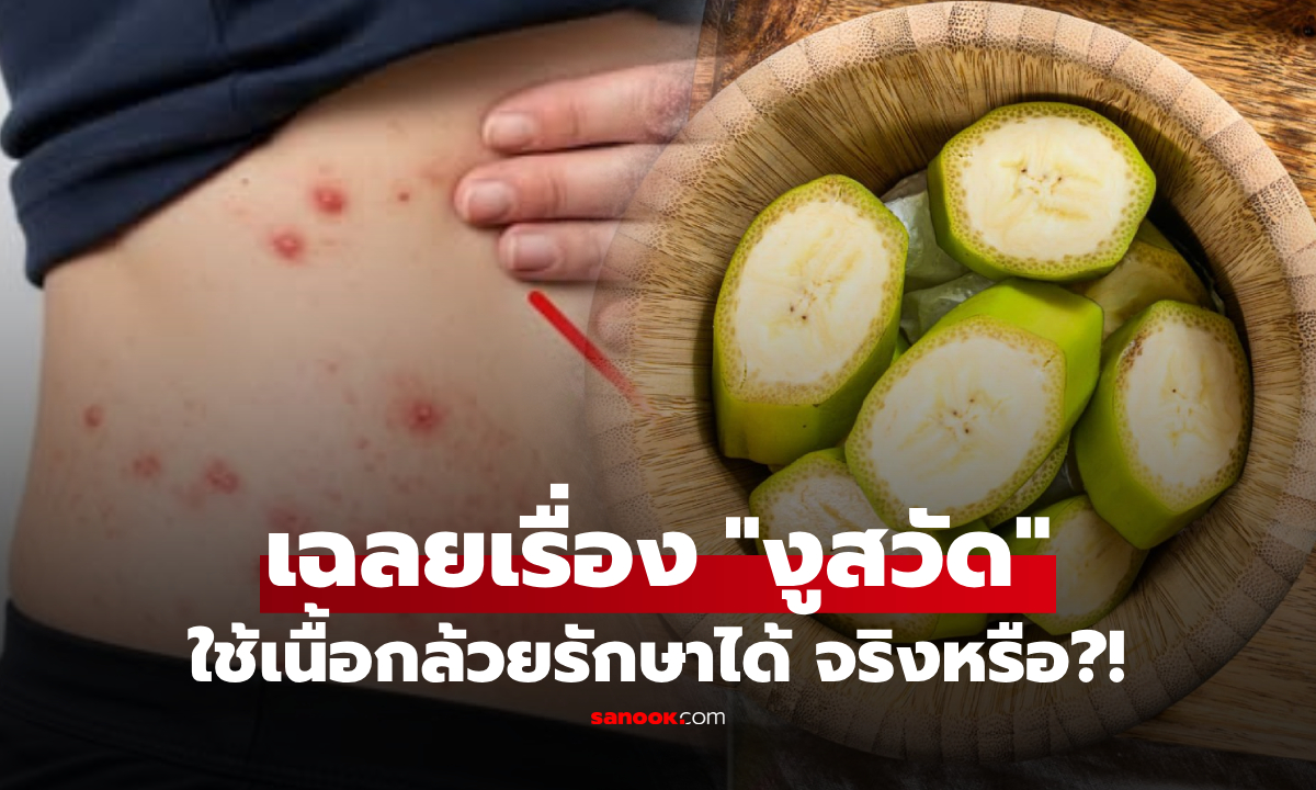 อ.เจษฎ์ เฉลยแล้ว "งูสวัด" ขึ้นรอบเอวแล้วต้องตาย แต่ใช้เนื้อกล้วยรักษาได้ จริงหรือ?!