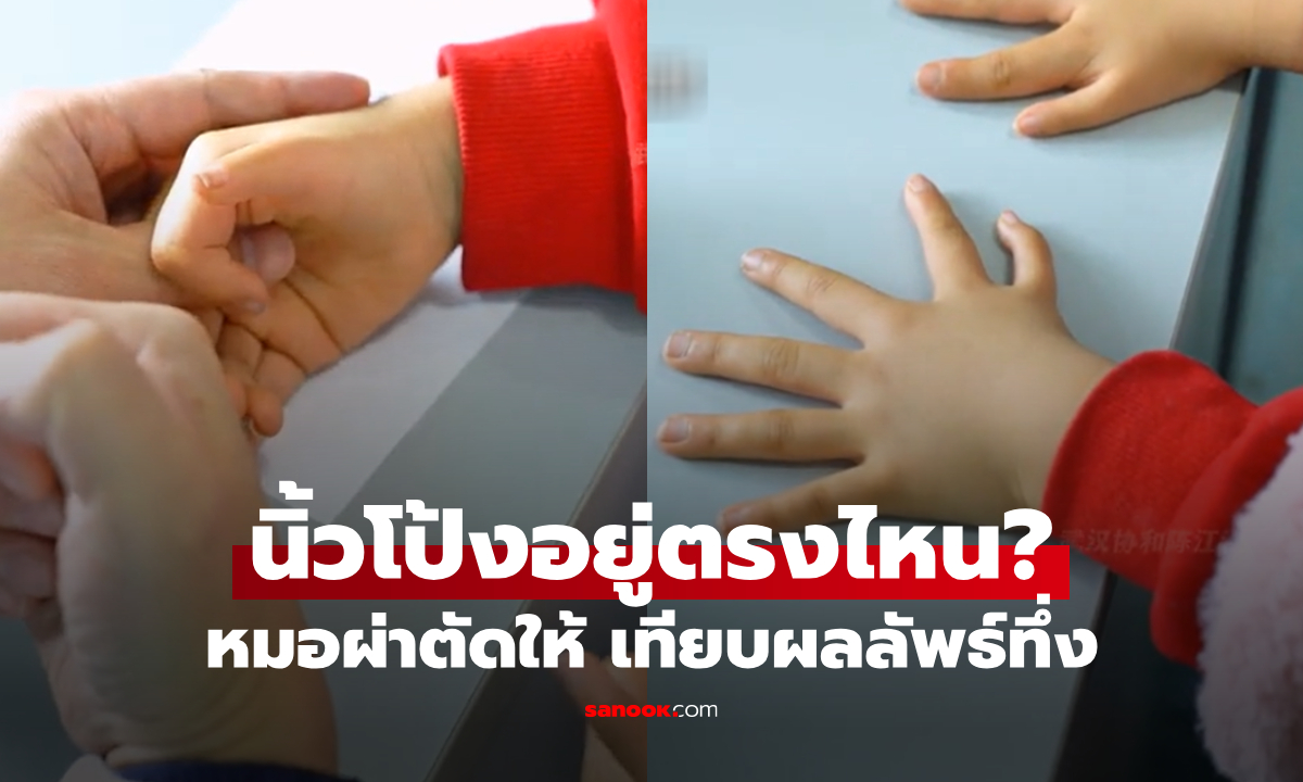 ด.ญ.นิ้วมือไม่เหมือนใคร คนแห่สงสัย "นิ้วโป้งอยู่ตรงไหน?" หมอผ่าตัดให้ เทียบผลลัพธ์น่าทึ่ง