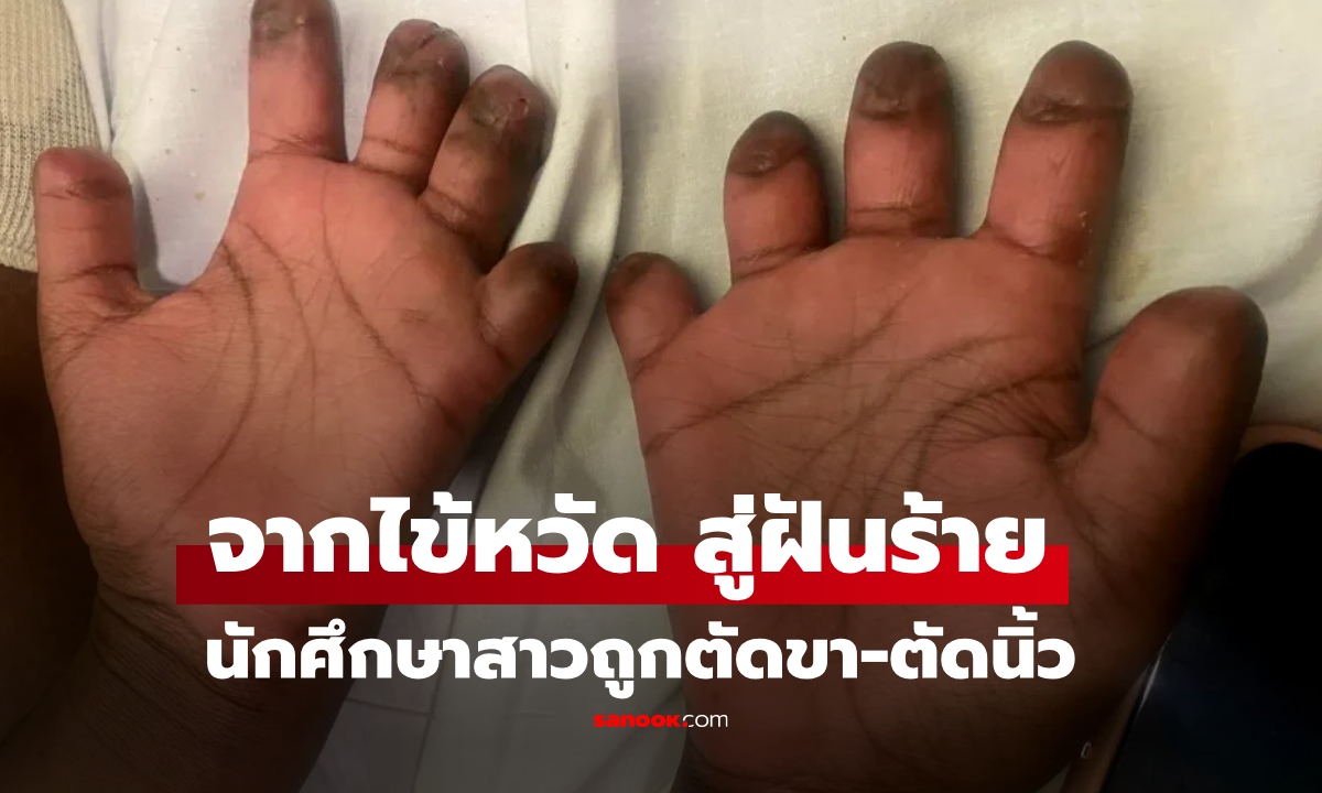 จากไข้หวัดธรรมดาสู่ฝันร้าย นักศึกษาสาวถูกตัดขาตัดนิ้ว หลังป่วยจนหมดสติ