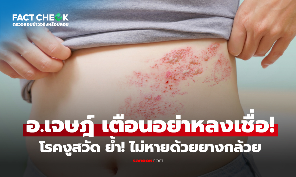 อ.เจษฎ์ เตือนอย่าหลงเชื่อ! โรคงูสวัด กับความเชื่อผิดๆ ย้ำไม่หายด้วยยางกล้วย