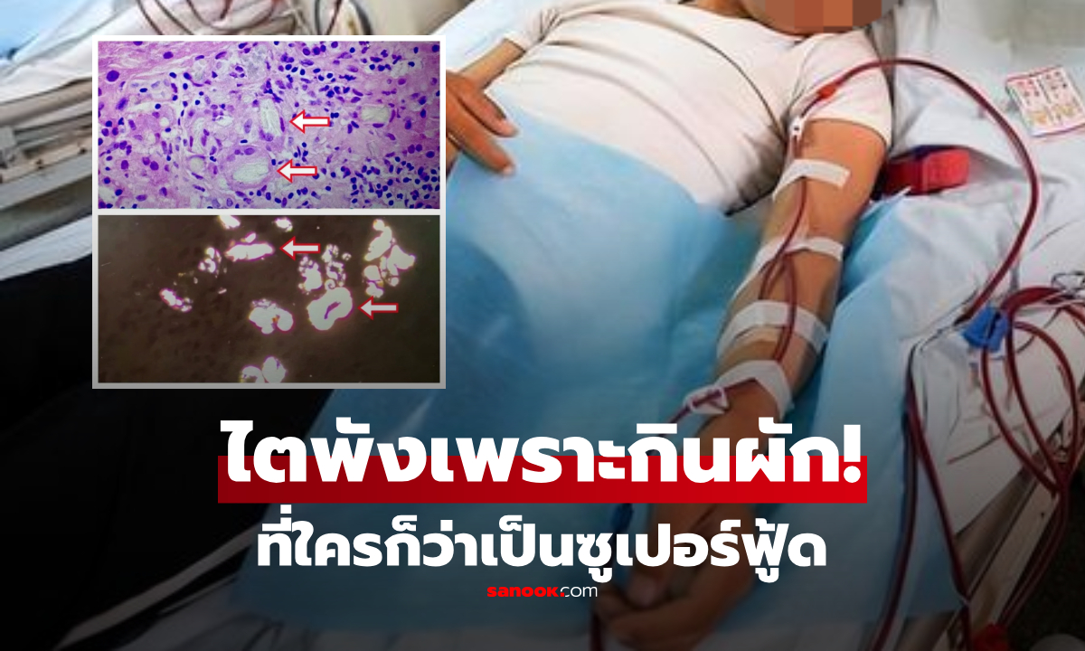 ช็อก ชายจีน “ไตวาย” หลังกินผักชนิดนี้ทุกวัน ที่ใครก็ว่าเป็นซูเปอร์ฟู้ด!!!