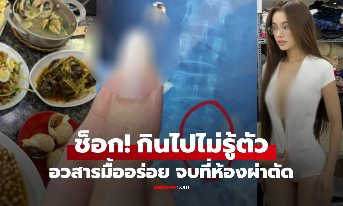 เสียวไส้! สาวสวยคนดัง กินหอยได้ "ของแถม" ต้องผ่าตัดยาว 6 ชม. ค่ารักษาแพงมาก