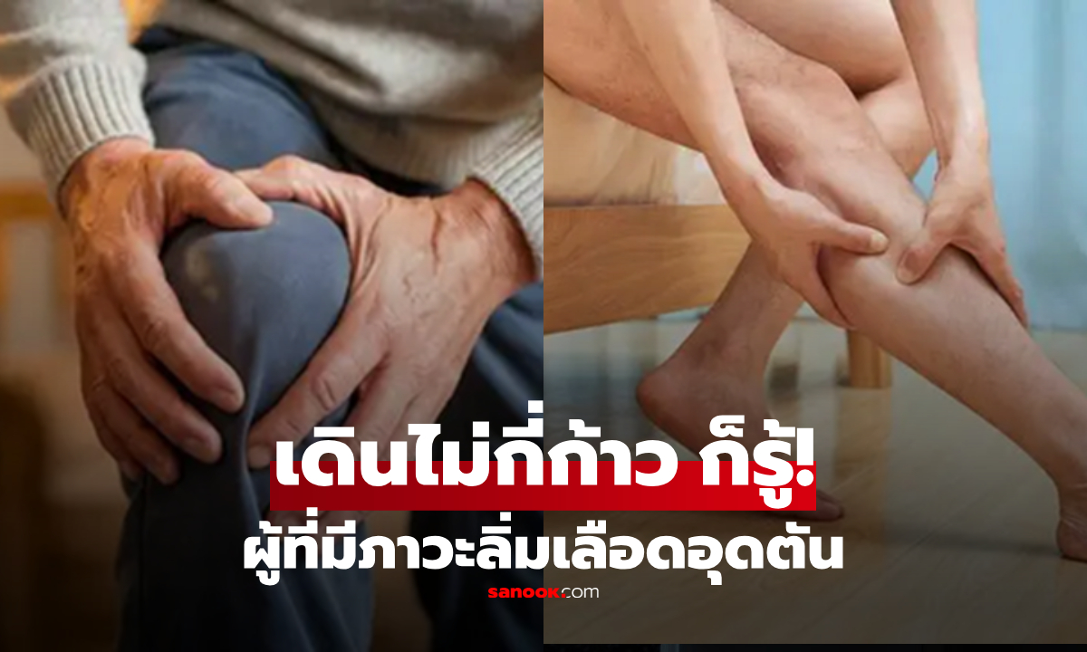 รู้ไว้ดีกว่า! ผู้มีภาวะลิ่มเลือดอุดตัน สังเกตได้ "ขณะเดิน" อาการออก แต่หลายคนกลับมองข้าม