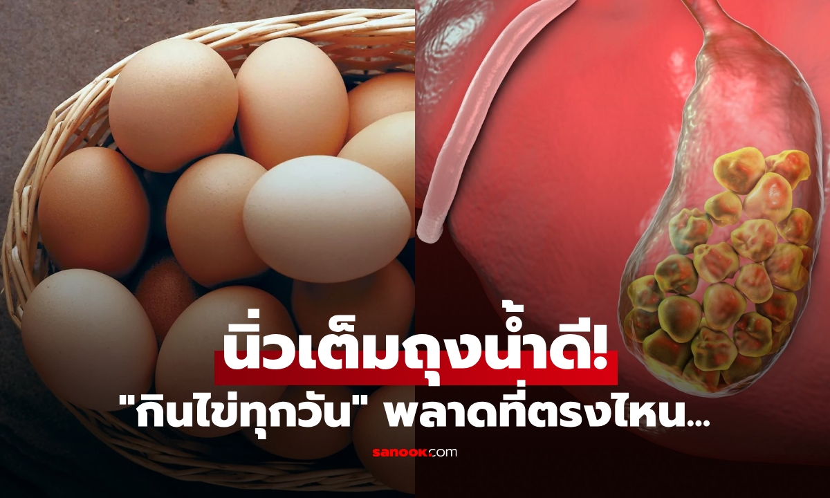 หนุ่มวัย 23 นิ่วใหญ่เต็มถุงน้ำดี แค่เพราะ "กินไข่ทุกวัน" กลับต้องทรมาน หมอชี้จุดพลาด?!