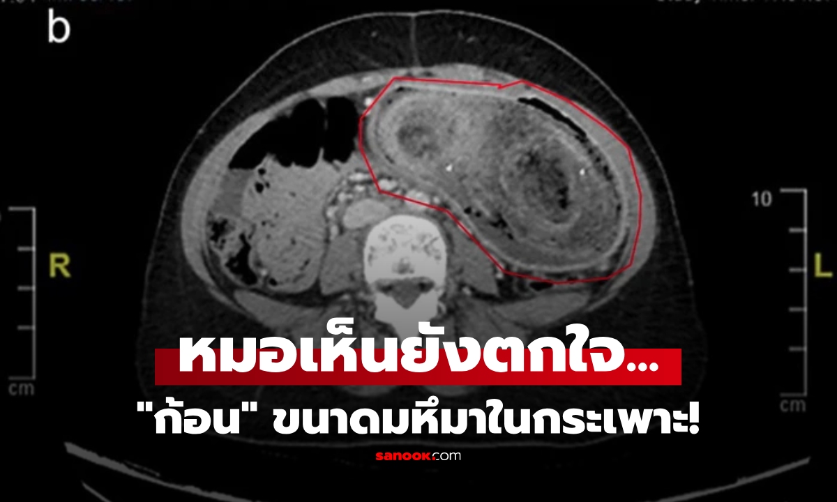 เด็กสาววัย 17 ปวดท้อง-อาเจียนไม่หยุด หมอตกใจเห็น "ก้อน" ขนาดมหึมาในกระเพาะ!