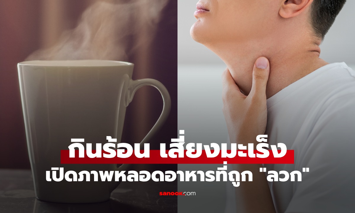 หมอเตือน "กินของร้อน" อันตรายกว่าที่คิด เปิดภาพหลอดอาหารที่ถูก "ลวก" เสี่ยงเป็นมะเร็ง