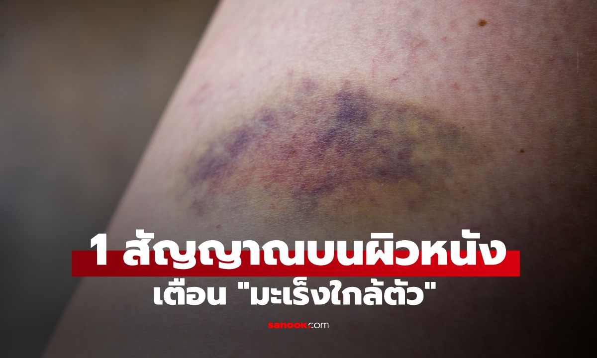 1 สัญญาณบนผิวหนังเตือน "มะเร็งใกล้ตัว" แพทย์แนะนำให้รีบไปตรวจทันทีที่พบ