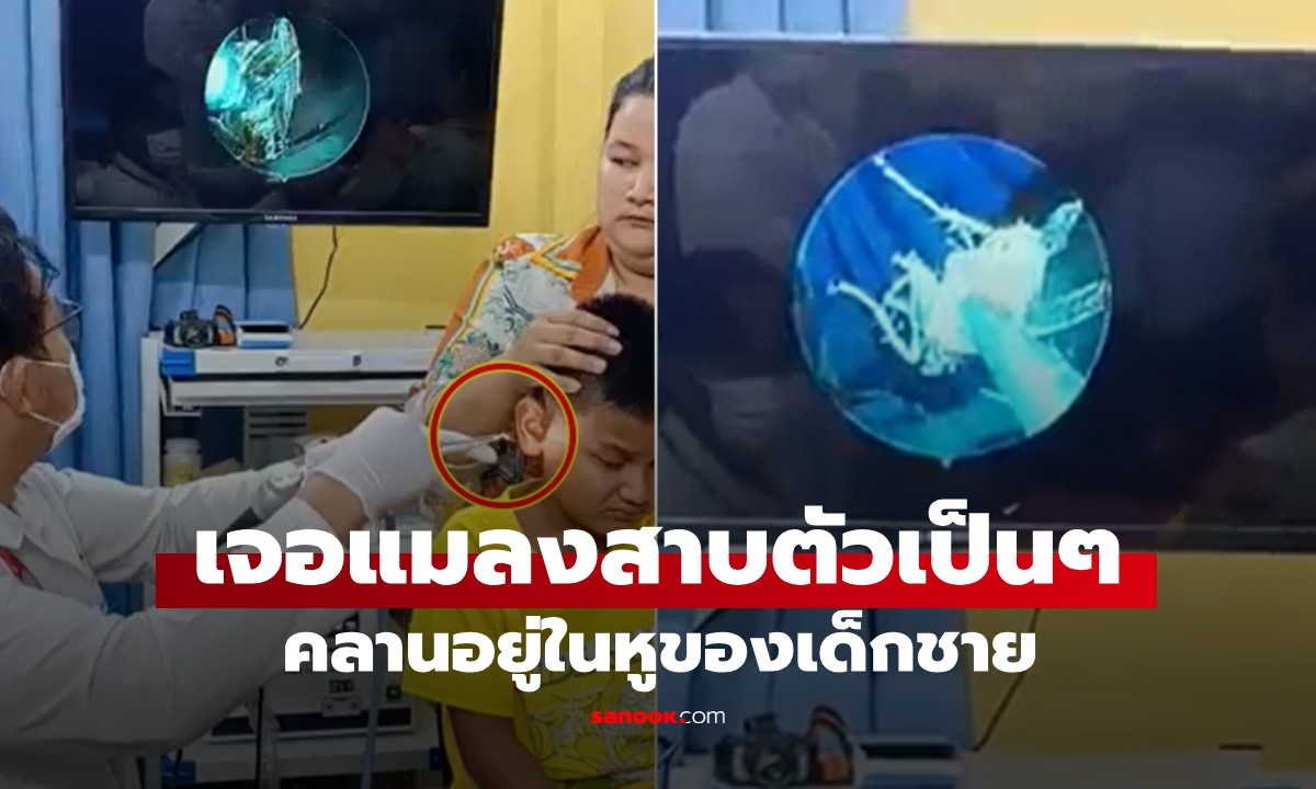 ลูกชายบ่นปวดหู แม่อึ้ง! หมออึ้ง! เจอ "แมลงสาบ" ตัวเป็นๆ เคลื่อนไหวอยู่ข้างในหู (มีคลิป)