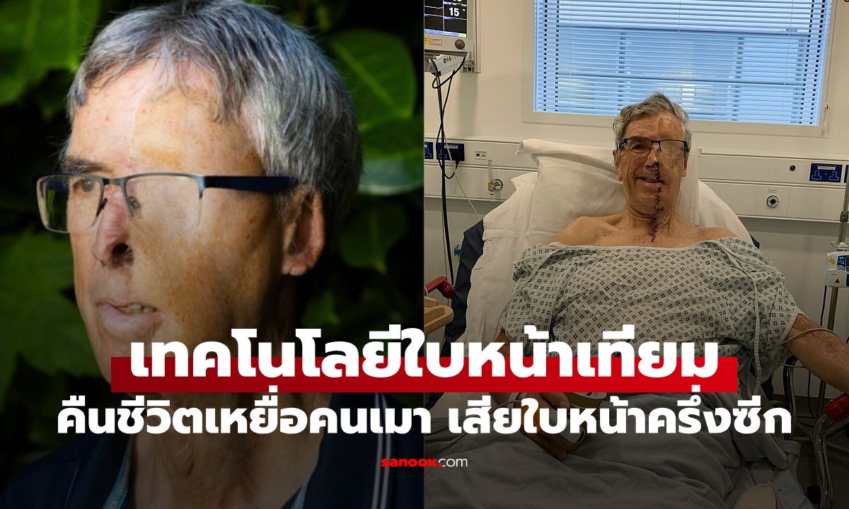 สุดทึ่งเทคโนโลยี "ใบหน้าเทียม" คืนชีวิตให้เหยื่อเมาแล้วขับ สูญเสียใบหน้าครึ่งซีก