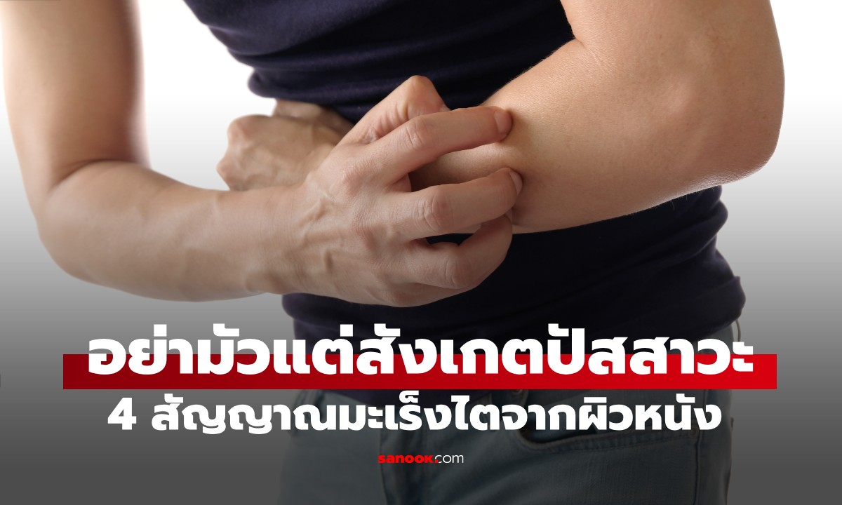 หมอเตือน 4 สัญญาณ "มะเร็งไต" ที่อาจปรากฏบนผิวหนัง อย่ามัวแต่สังเกตปัสสาวะ