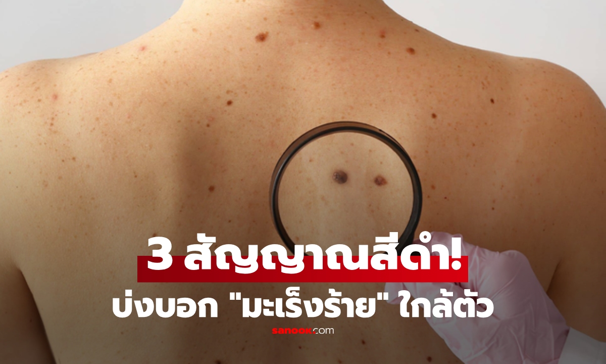 ไม่ใช่แค่ไฝ! เผยครบ "3 สัญญาณสีดำ" ที่ปรากฏบนร่างกาย บ่งบอกมะเร็งร้ายใกล้ตัว