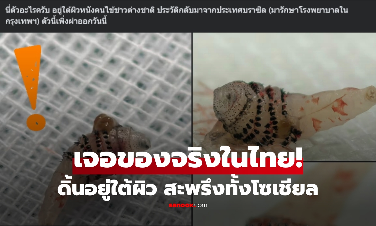 เฉลยแล้ว "ตัวอะไร" หมอในกรุงเทพฯ เจออยู่ใต้ผิวหนังชาวต่างชาติ ใครเห็นก็สะพรึง!