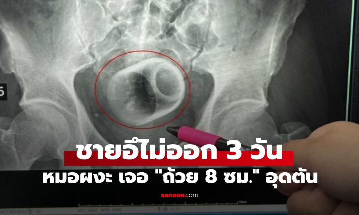 ชายปวดท้องหนัก 3 วัน ถ่ายไม่ออก! หมอผงะ เจอ "ถ้วยเซรามิก 8 ซม." อุดช่องทวาร