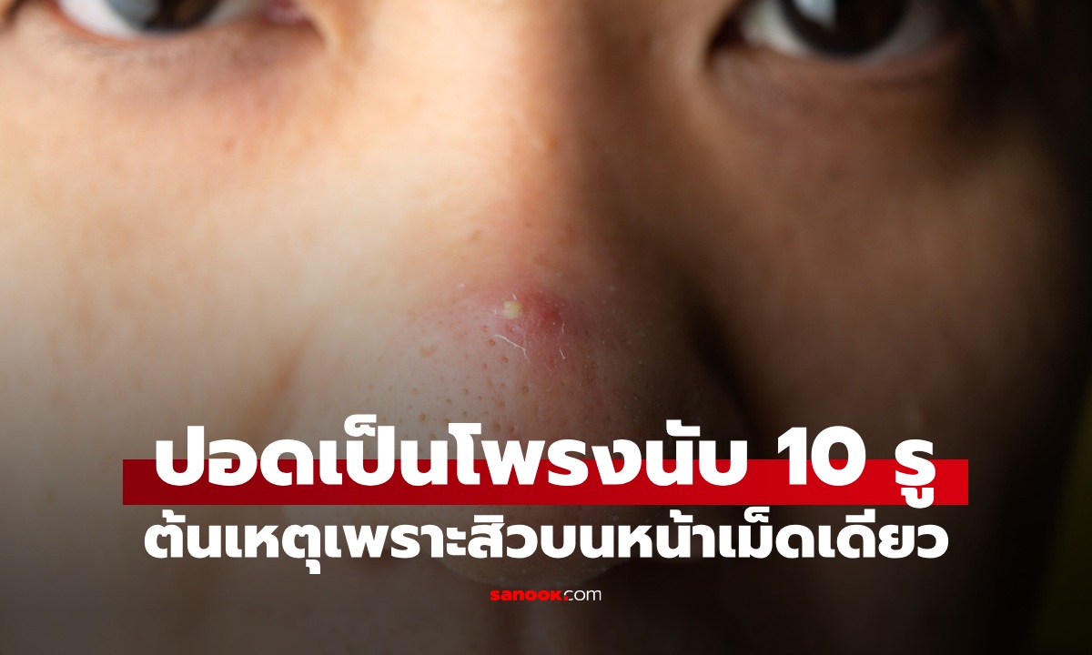 หนุ่มปอดมีโพรง มากกว่า 10 รู ไม่อยากจะเชื่อต้นเหตุเพราะ "สิวเม็ดเดียว" บนหน้า