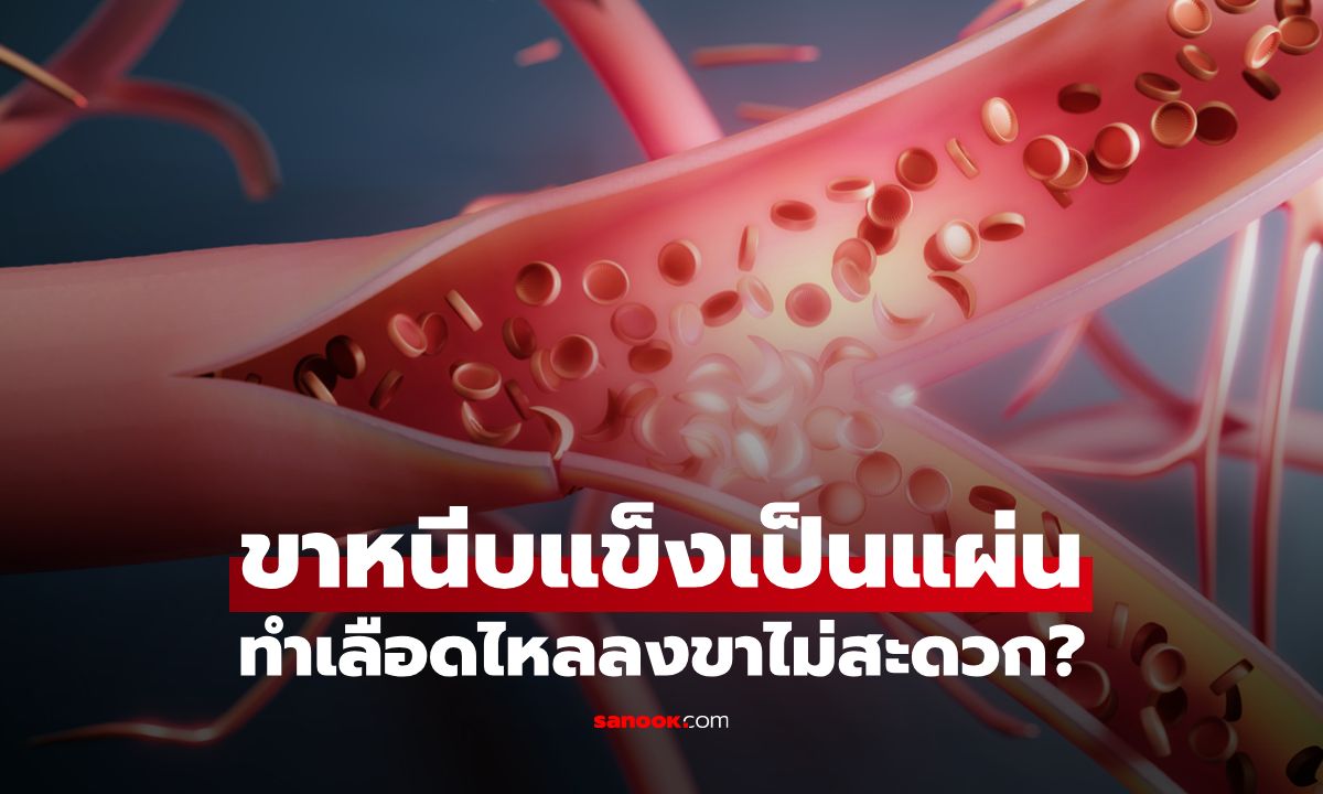 เช็กข่าวชัวร์ : ขาหนีบแข็งเป็นแผ่นทำเลือดไหลลงขาไม่สะดวก เสี่ยงความดันโลหิตสูง?