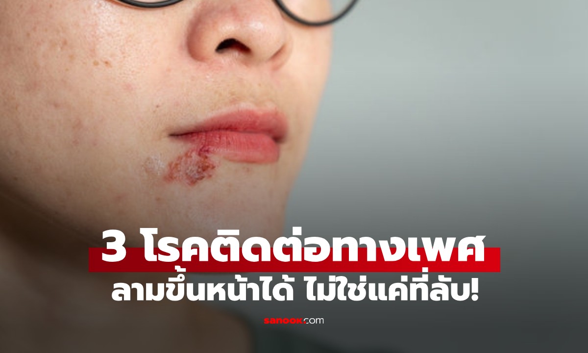 ไม่ได้มีแค่ที่ลับ! หมอเตือน "3 โรคติดต่อทางเพศสัมพันธ์" ลามขึ้นหน้าได้ ระวังเสียโฉม