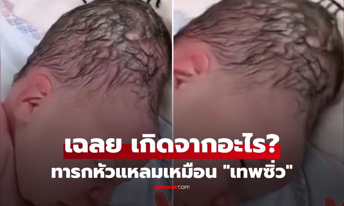 สมองเบี้ยว?! แม่ใจหล่นวูบ ลูกคลอดมา "หัวแหลม" จนญาติไม่กล้าอุ้ม หมอรีบเฉลยความจริง