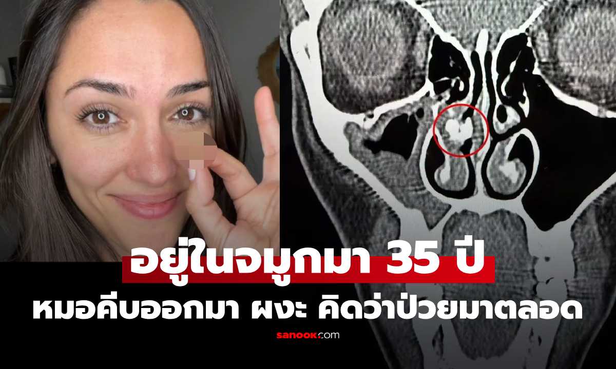 หญิงวัย 35 ป่วยไซนัสทั้งชีวิต ก่อนหมอพบ "สิ่งแปลกปลอม" ในจมูก คีบออก ผงะ! คาดติดมาตั้งแต่แรกคลอด