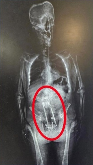 ชายชาวฟลอริดาคนหนึ่งซ่อนกระบอกน้ำร้อนไว้ในทวารหนักของเขา และถูกตรวจพบโดยเครื่องสแกนร่างกายขณะถูกจับกุมในข้อหาเกี่ยวกับยาเสพติด