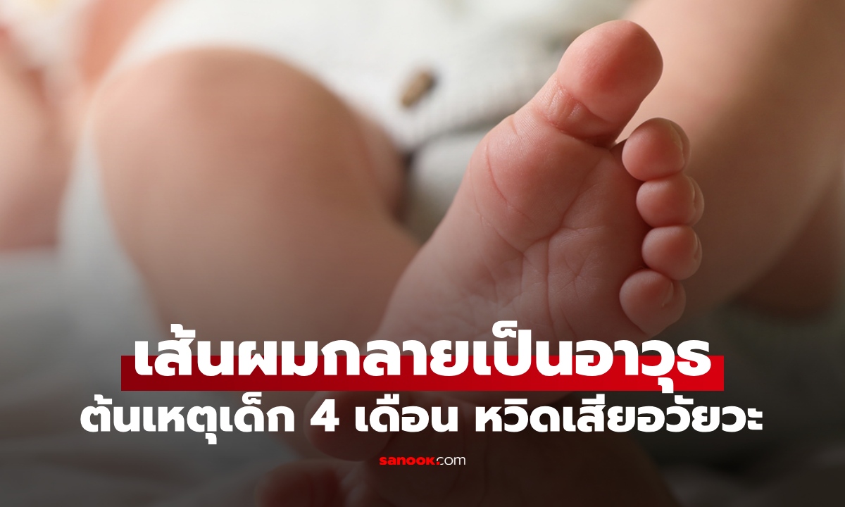 "ผมเส้นเดียว" กลายเป็นอาวุธร้ายแรง ต้นเหตุทารกวัย 4 เดือน เกือบสูญเสียอวัยวะ