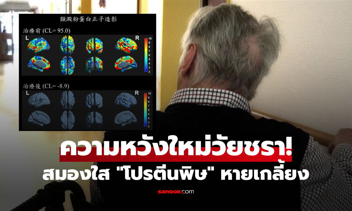 ปาฏิหาริย์การแพทย์! เถ้าแก่วัย 76 ป่วยอัลไซเมอร์ "รับยาใหม่" 6 เดือน สมองกลับมาใสปิ๊ง