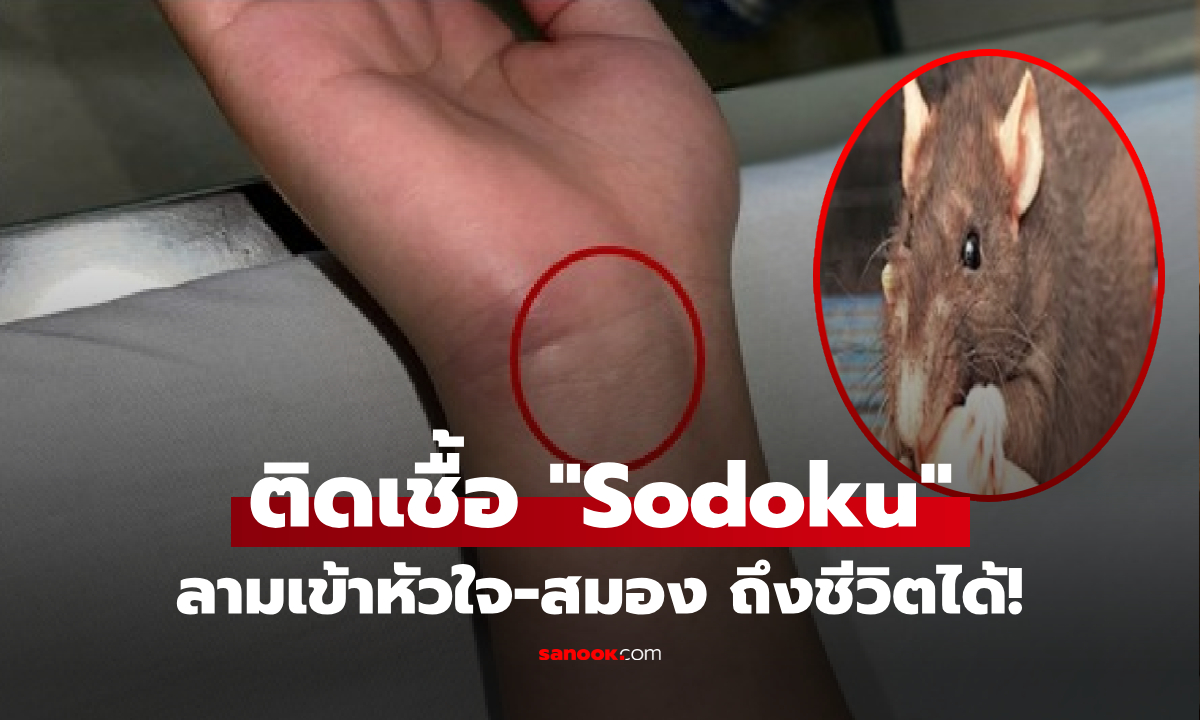 "หนูกัด" เด็ก 16 ไข้สูง ติดเชื้อ "Sodoku" จากแผลข้อมือ ถ้าลามเข้าหัวใจ-สมอง ถึงชีวิตได้!!