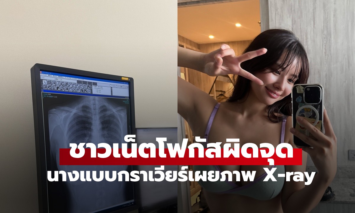 นางแบบกราเวียร์เผยภาพ X-ray อวด "ปอดสะอาด" แต่ชาวเน็ตโฟกัสผิดจุด ยอดวิวพุ่ง 30 ล้าน