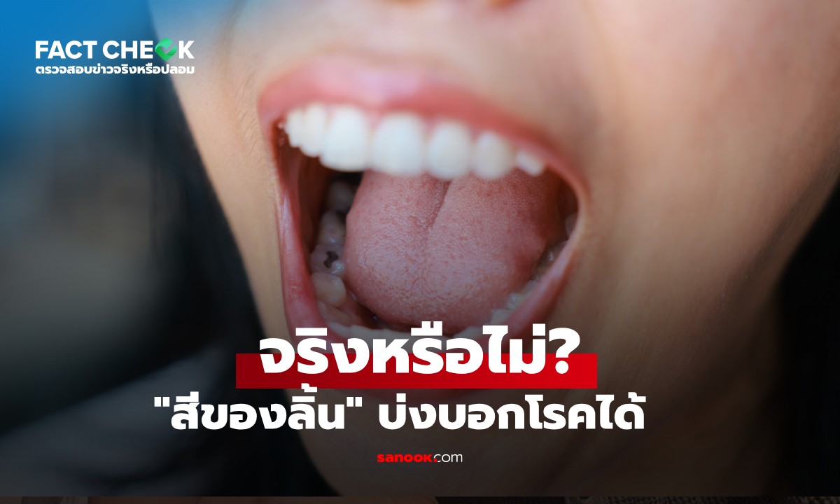"สีลิ้น" สามารถบ่งบอกความผิดปกติของร่างกายและโรคต่างๆ ได้จริงหรือไม่? : เช็กข่าวชัวร์