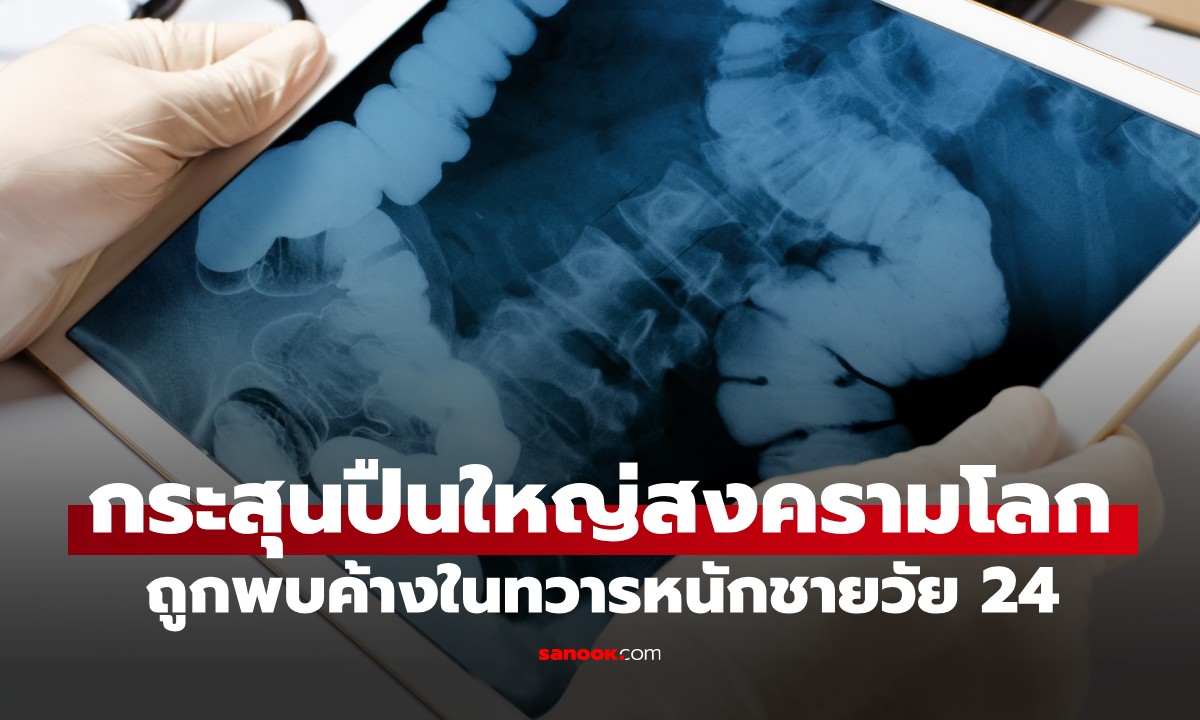 รพ.ผวาสั่งอพยพด่วน! หนุ่มวัย 24 ทำ "กระสุนปืนใหญ่สงครามโลก" ค้างในทวารหนัก