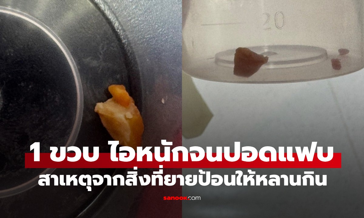 อุทาหรณ์ เด็ก 1 ขวบ ไอหนักจน "ปอดแฟบ" หมอยังเดือด! สาเหตุจากสิ่งที่ยายป้อน