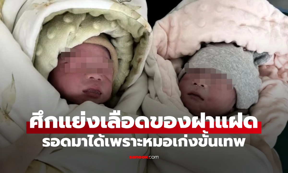ฝาแฝดเปิดศึก "แย่งเลือด" ใช้รกร่วมกันเสี่ยงตายทั้งคู่ รอดเพราะหมอเก่งขั้นเทพ
