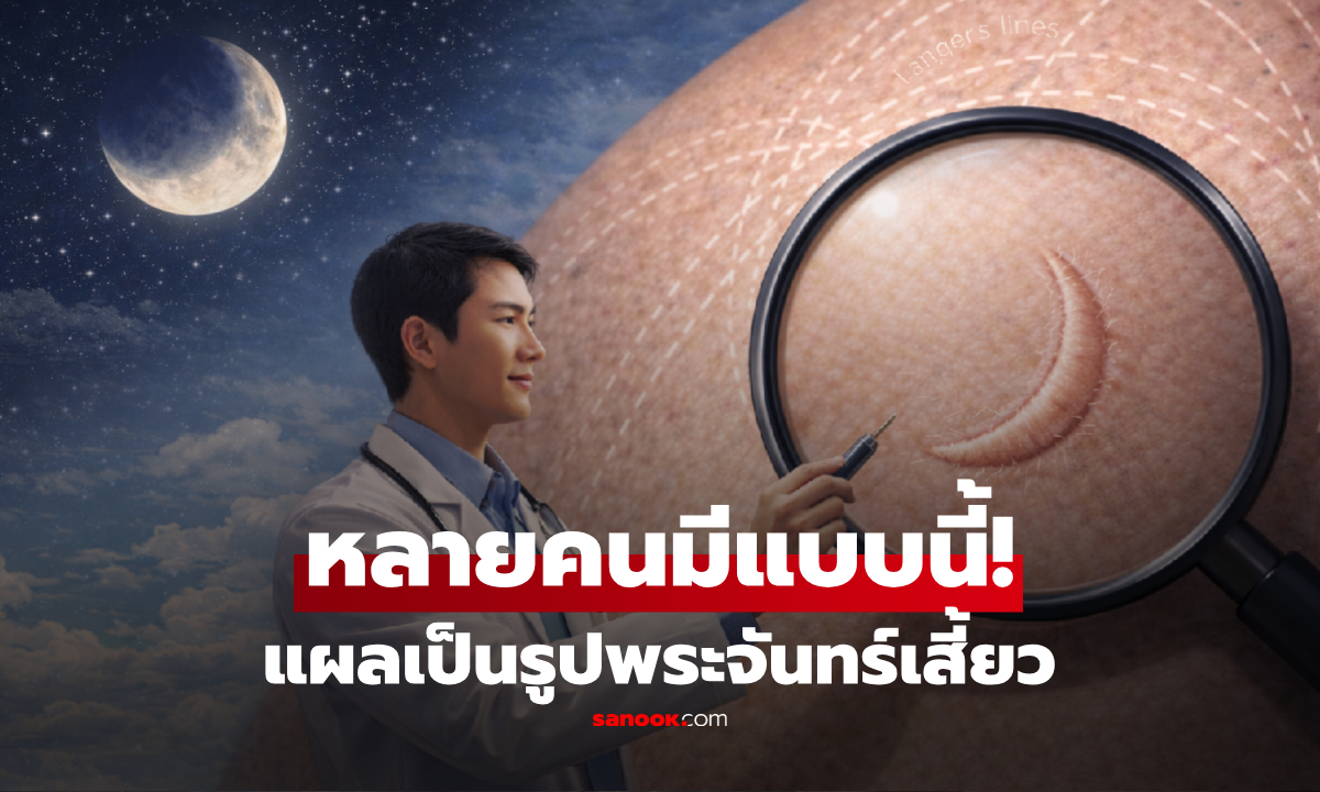 "แผลเป็น" บางชนิด ทำไมจึงโค้งคล้าย "พระจันทร์เสี้ยว" สรุปสาเหตุเกิดจากอะไร?