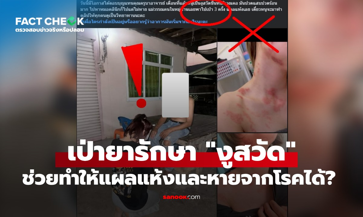 เป็น "งูสวัด" ใช้วิธีการทำพิธีเป่าไป 3 ครั้ง จนแผลแห้งได้ จริงหรือไม่? : เช็กข่าวชัวร์