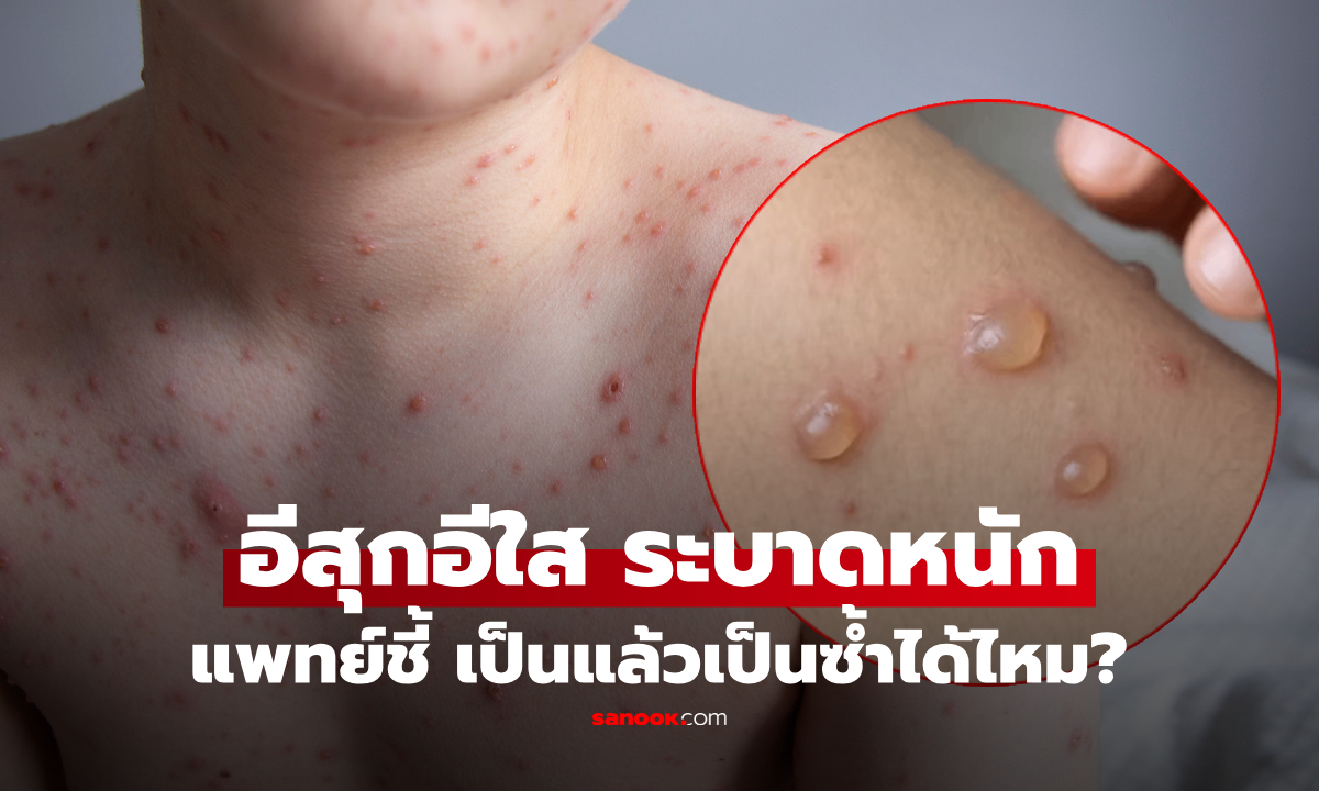 "อีสุกอีใส" กำลังระบาด หลังพบคลัสเตอร์หลักหมื่น แพทย์เฉลย คนเป็นแล้วเป็นซ้ำได้หรือไม่?