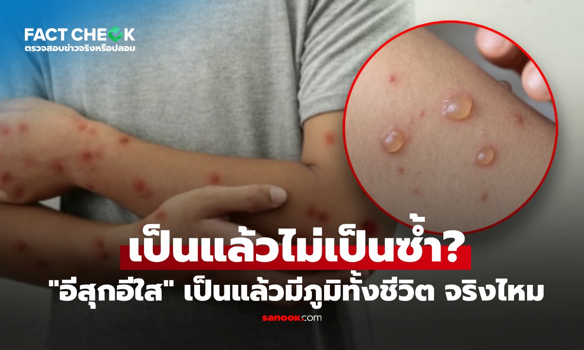 "อีสุกอีใส" คนเป็นแล้ว เป็นซ้ำได้ไหม? หมอไขกระจ่าง เรื่องที่หลายคนยังเข้าใจผิด : เช็กข่าวชัวร์