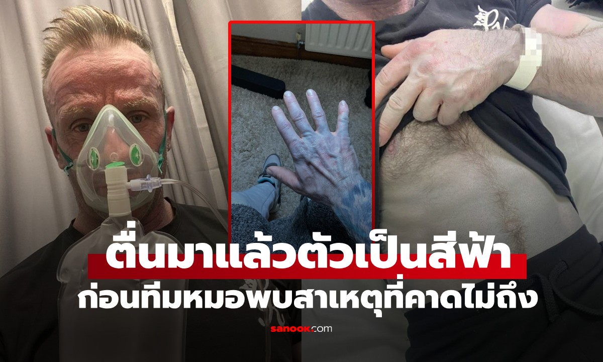 หนุ่มแทบช็อก! ตัวกลายเป็นสีฟ้าทั้งร่าง นึกว่าป่วยหนัก รู้สาเหตุทีมแพทย์ขำลั่นรพ.